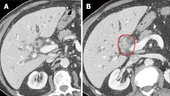 klitskin%20tumor%204