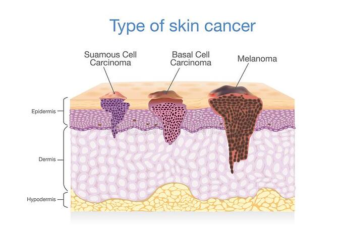 skin-layer-have-type-cancer-one-illustration-medical-diagram-100434292