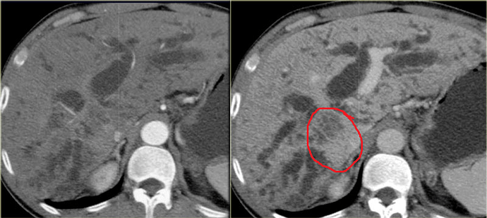 klitskin%20tumor%202