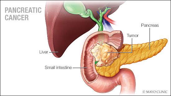 a-medical-illustration-of-pancreatic-cancer-16X9